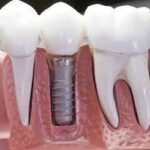 Dental insurance that covers dental implants: which is the best?
