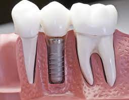 Dental insurance that covers dental implants: which is the best?