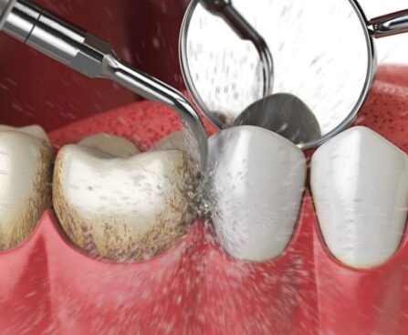 dental implants in houston tx