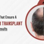 Factors-That-Ensure-a-Great-Hair-Transplant-Results