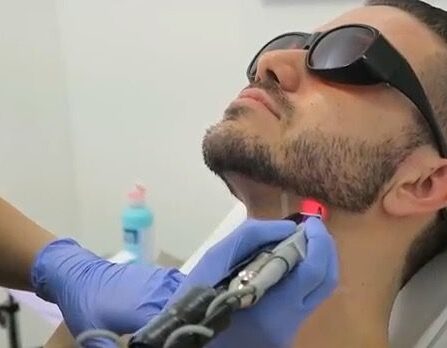 Exploring Laser Beard Shaping: Procedures and Benefits