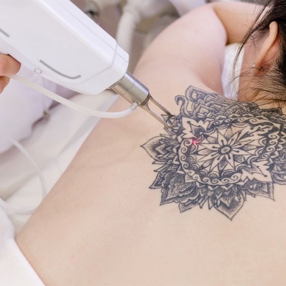 laser tattoo removal fort lauderdale
